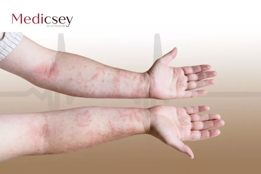 Causes and treatment of allergic dermatitis in Turkey